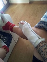 Carollo campodarsego dito fratturato